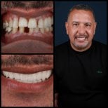 Resultados de implantes dentales antes y después en Mira Clinic, sonrisa restaurada y dientes alineados