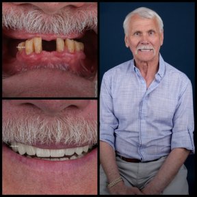 Resultado antes y después de implantes dentales All-on-4 en Mira Clinic, sonrisa restaurada
