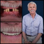 Resultado antes y después de implantes dentales All-on-4 en Mira Clinic, sonrisa restaurada