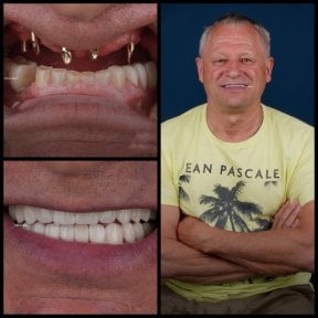 Vorher-nachher-Ergebnisse Hollywood Smile Implantate bei Mira Clinic, verbesserte Ästhetik