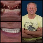 Vorher-nachher-Ergebnisse Hollywood Smile Implantate bei Mira Clinic, verbesserte Ästhetik