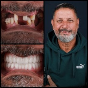 Before and after All-on-6 dental implants result at Mira Clinic, restored smile transformation