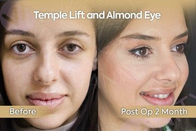 before-after photo endoscopic-facelift