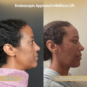 before-after photo endoscopic-facelift