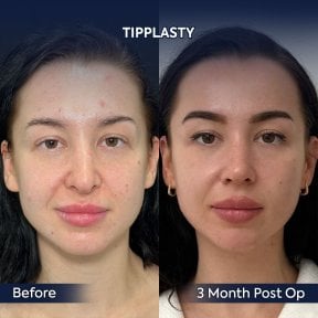before-after photo endoscopic-facelift