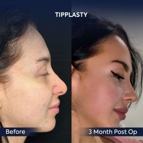 before-after photo endoscopic-facelift
