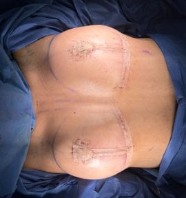 Breast augmentation result at Lucio Santos Plastic Surgery with visible post-surgery bandages