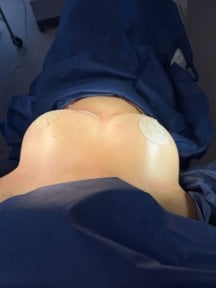 Breast augmentation result at Lucio Santos Plastic Surgery, enhanced breast shape post-surgery