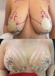 Before and after breast augmentation at Lucio Santos Plastic Surgery, visible lift and contour result