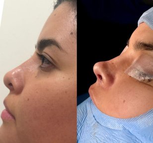 Результаты ринопластики до и после в Lucio Santos Plastic Surgery, изменение формы носа