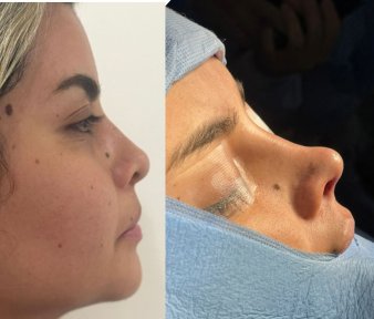 Результат ринопластики до и после в Lucio Santos Plastic Surgery, коррекция носа