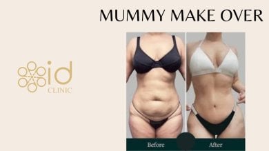 Результаты до и после маммопластики в ID Clinic Bangkok – преображение фигуры