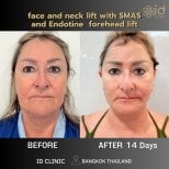 Результаты SMAS-лифтинга лица и шеи и подтяжки лба Endotine в ID Clinic Bangkok