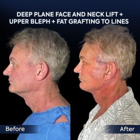 before-after photo deep-plane-facelift