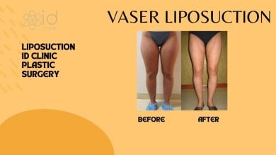 before-after photo brazilskaa-podtazka-agodic
