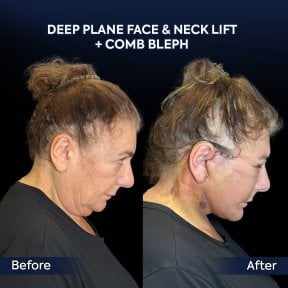 before-after photo deep-plane-facelift