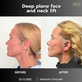 before-after photo glubokaya-podtyazhka-lica-deep-plane-facelift