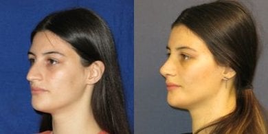 before-after photo rinoplastika-shirokogo-nosa