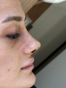 before-after photo rinoplastika-shirokogo-nosa