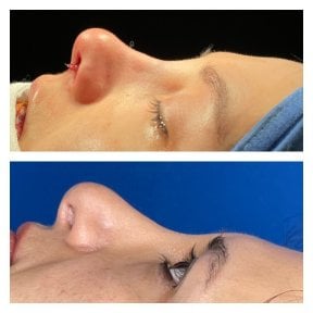 before-after photo rinoplastika-shirokogo-nosa