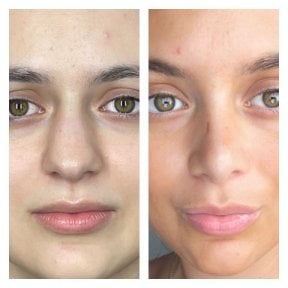 before-after photo rinoplastika-shirokogo-nosa