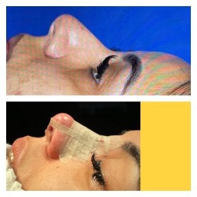 before-after photo rinoplastika-shirokogo-nosa