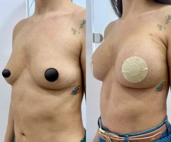 before-after photo mastopexy-breast-lift-contour-plastics
