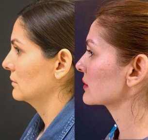 before-after photo deep-plane-facelift