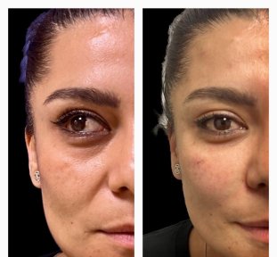 before-after photo botox-injections