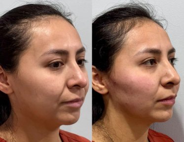 before-after photo botox-injections