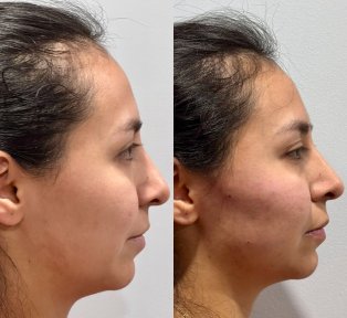 before-after photo botox-injections