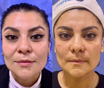 before-after photo botox-injections