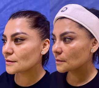 before-after photo botox-injections