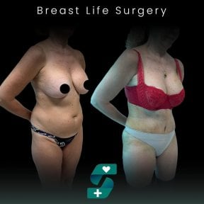 Before and after breast lift surgery results at Soraca Med, improved breast contour