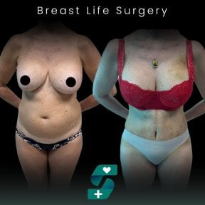 Before and after breast lift surgery results at Soraca Med, visible breast contour improvement