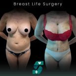 Before and after breast lift surgery results at Soraca Med, visible breast contour improvement