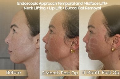 before-after photo neck-lift