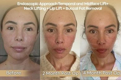 before-after photo neck-lift
