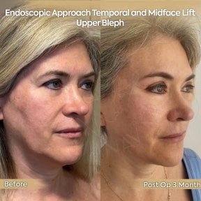 before-after photo neck-lift