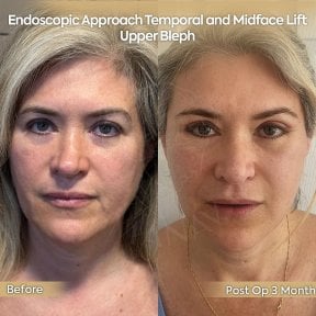 before-after photo neck-lift
