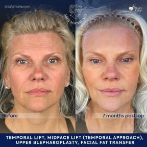 before-after photo neck-lift