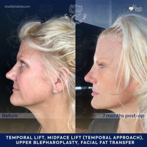 before-after photo neck-lift