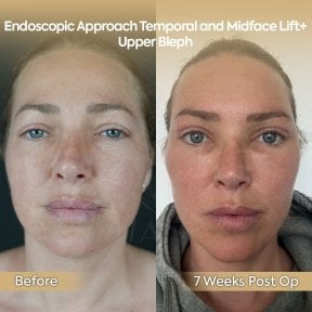 before-after photo neck-lift