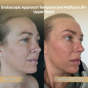 before-after photo neck-lift