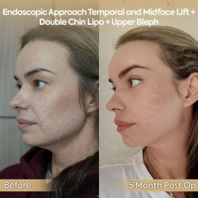 before-after photo neck-lift