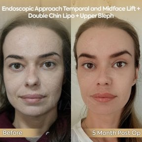 before-after photo neck-lift