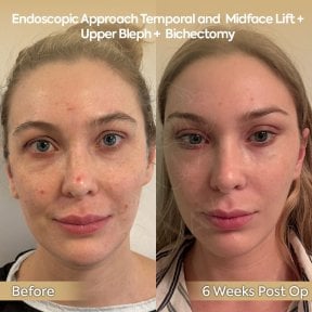 before-after photo neck-lift