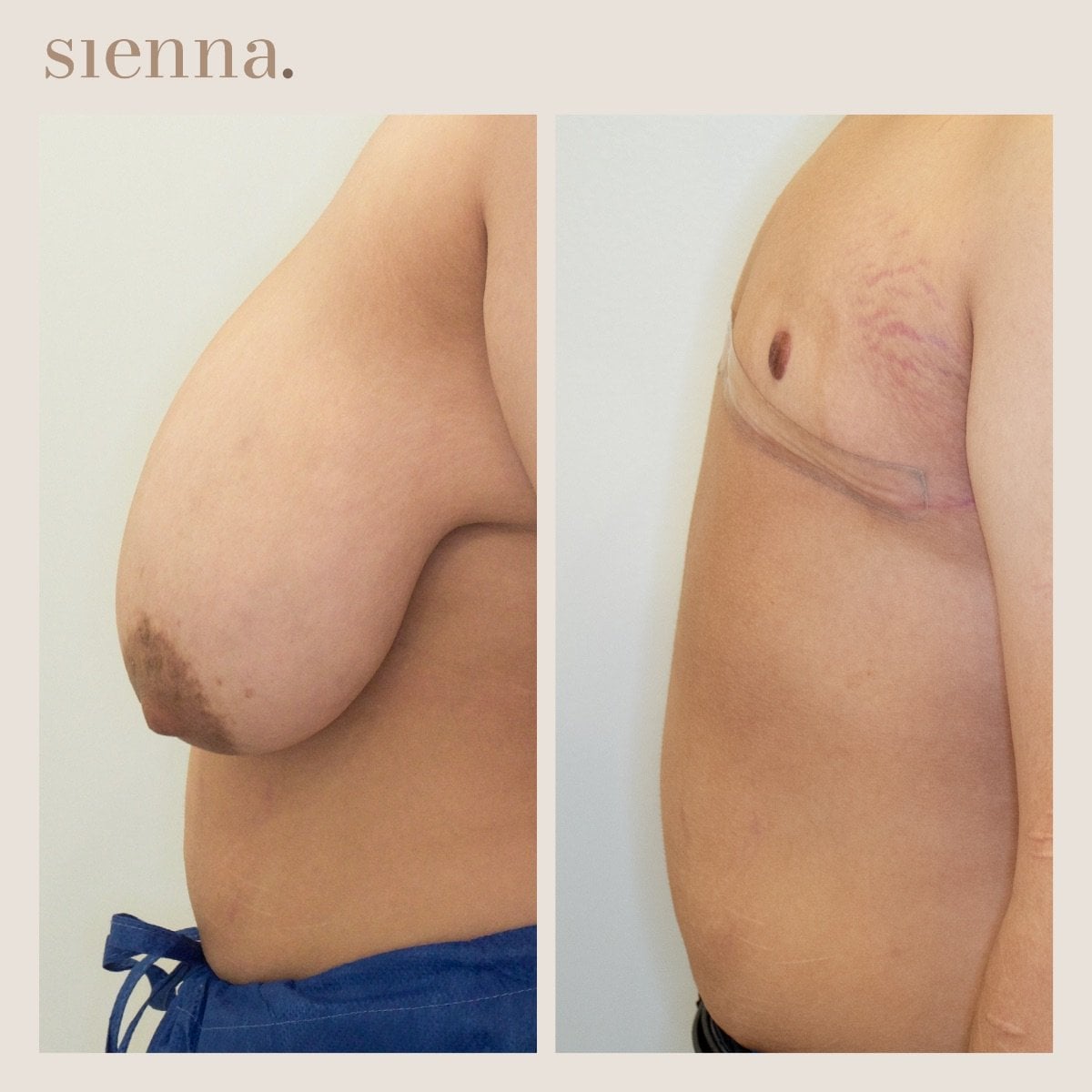 نتائج جراحة الصدر قبل وبعد في Sienna Clinic – تحول تذكير الصدر