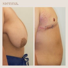 before-after photo top-surgery