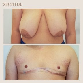 before-after photo top-surgery
